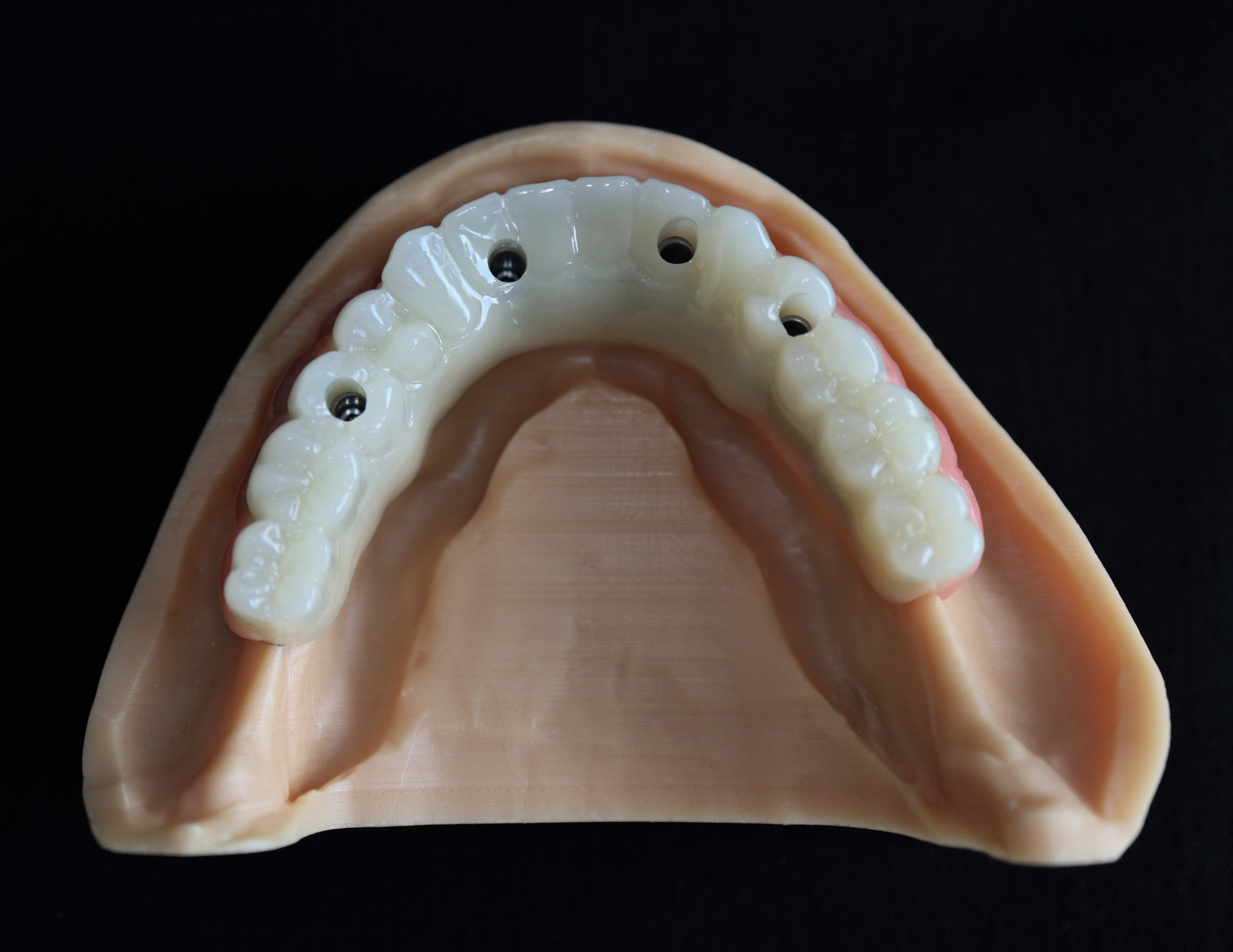 Fig. 5: Additively manufactured implant bar screwed to the dental implants supporting a complete denture.